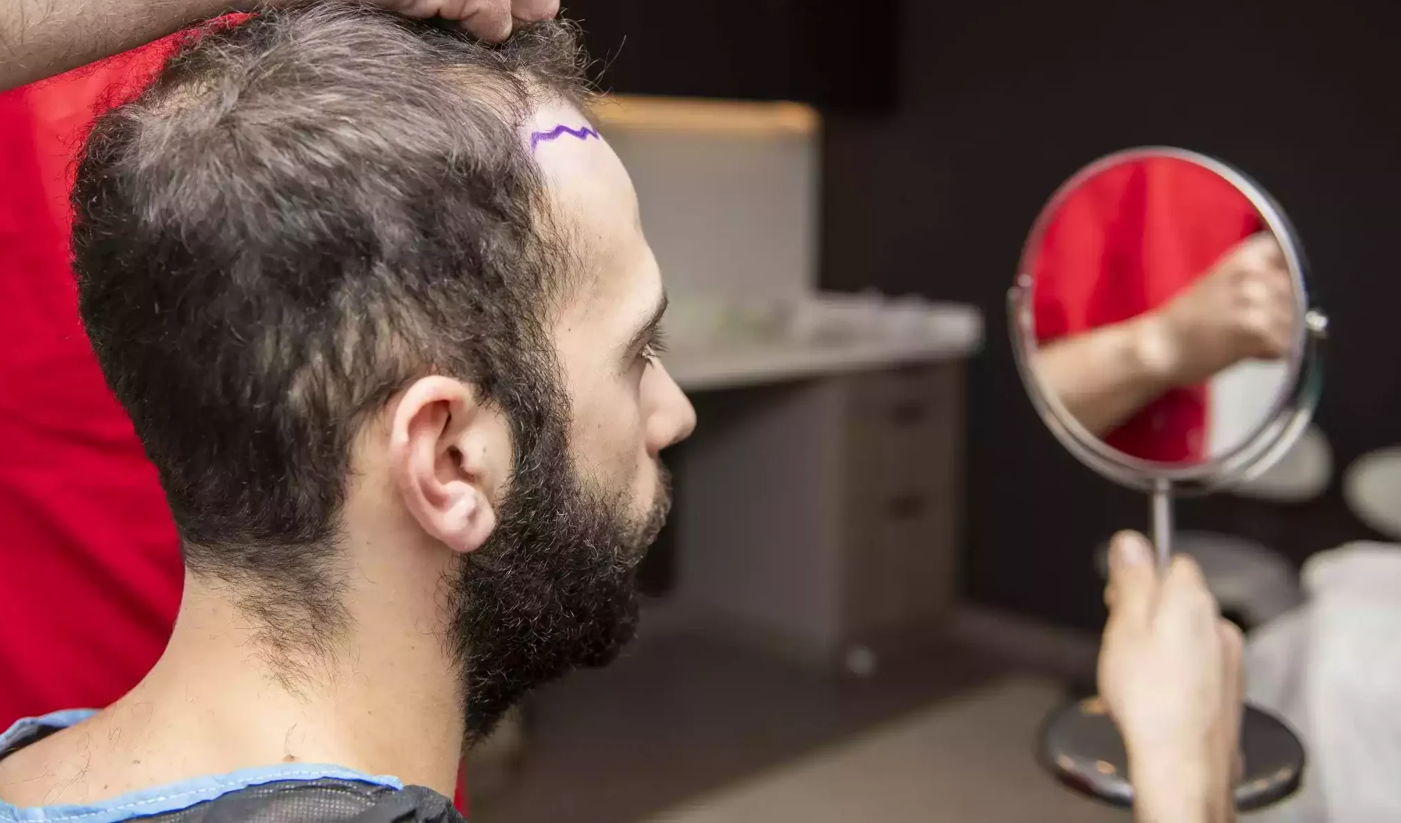 Adonis-Med-Hair-Transplant-FUE-Sapphire-min