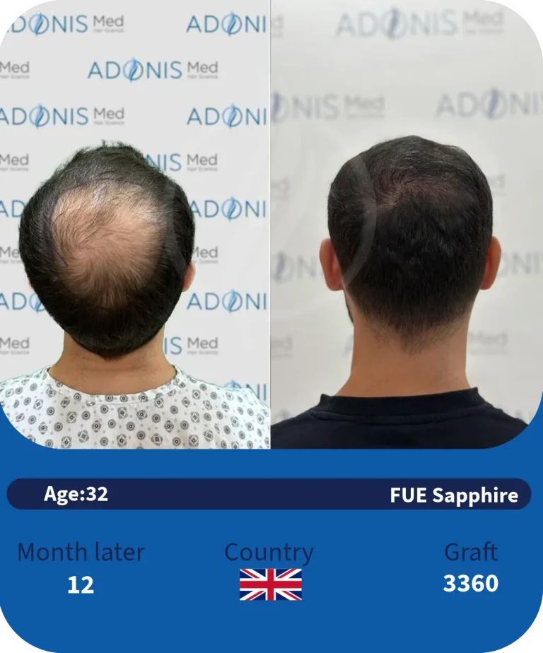 before-after-adonismed-hairtransplant (1)