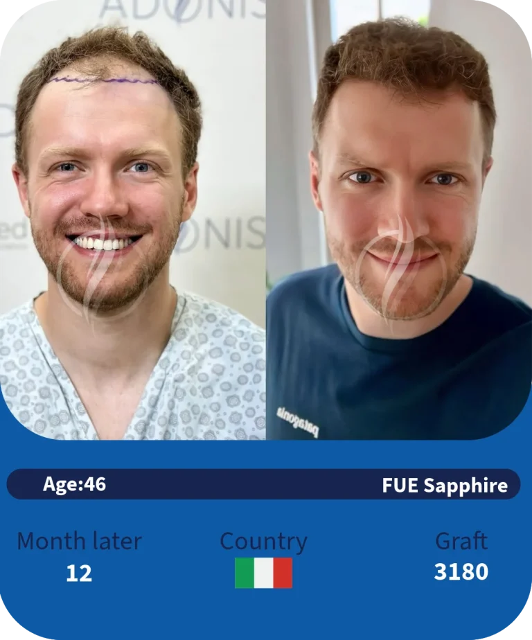 before-after-adonismed-hairtransplant (2)