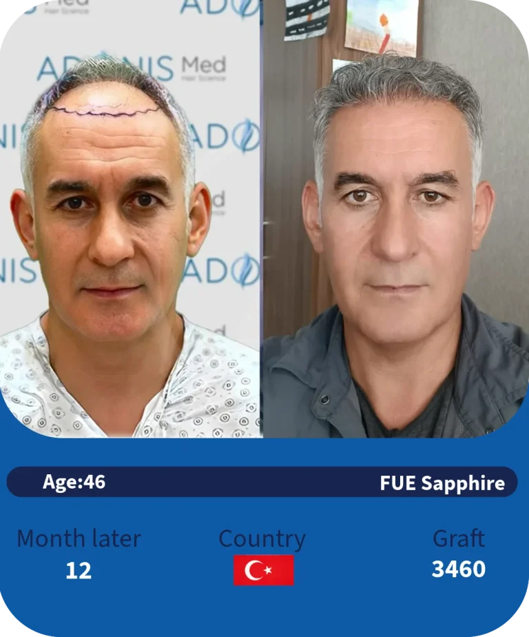 before-after-adonismed-hairtransplant (4)