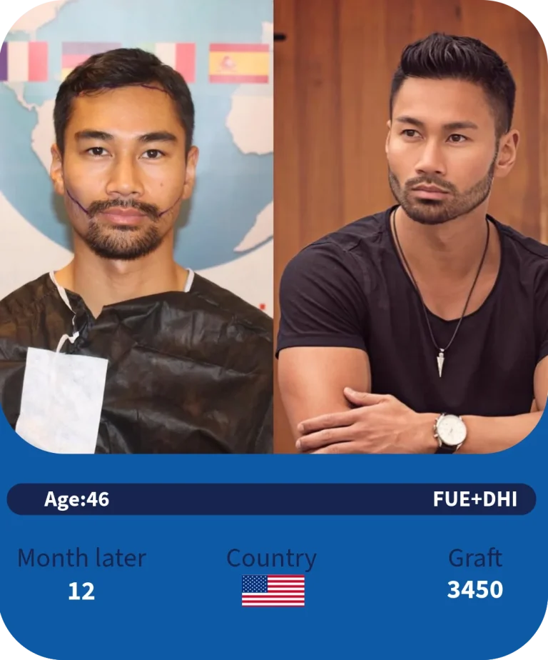 before-after-adonismed-hairtransplant (5)
