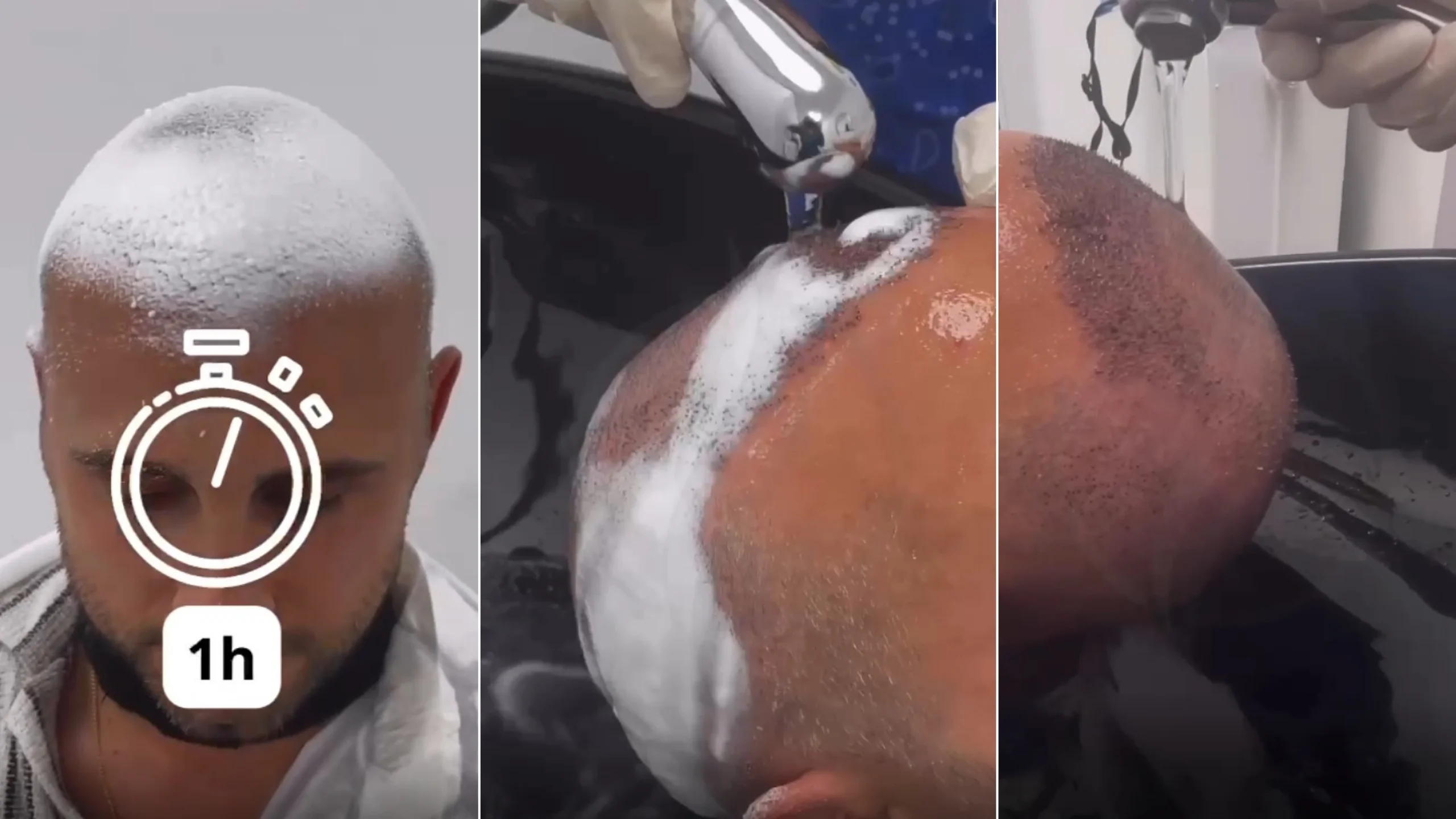 Nachsorge nach der Haartransplantation: Methoden zum Schutz der Grafts und zur Beschleunigung der Heilung