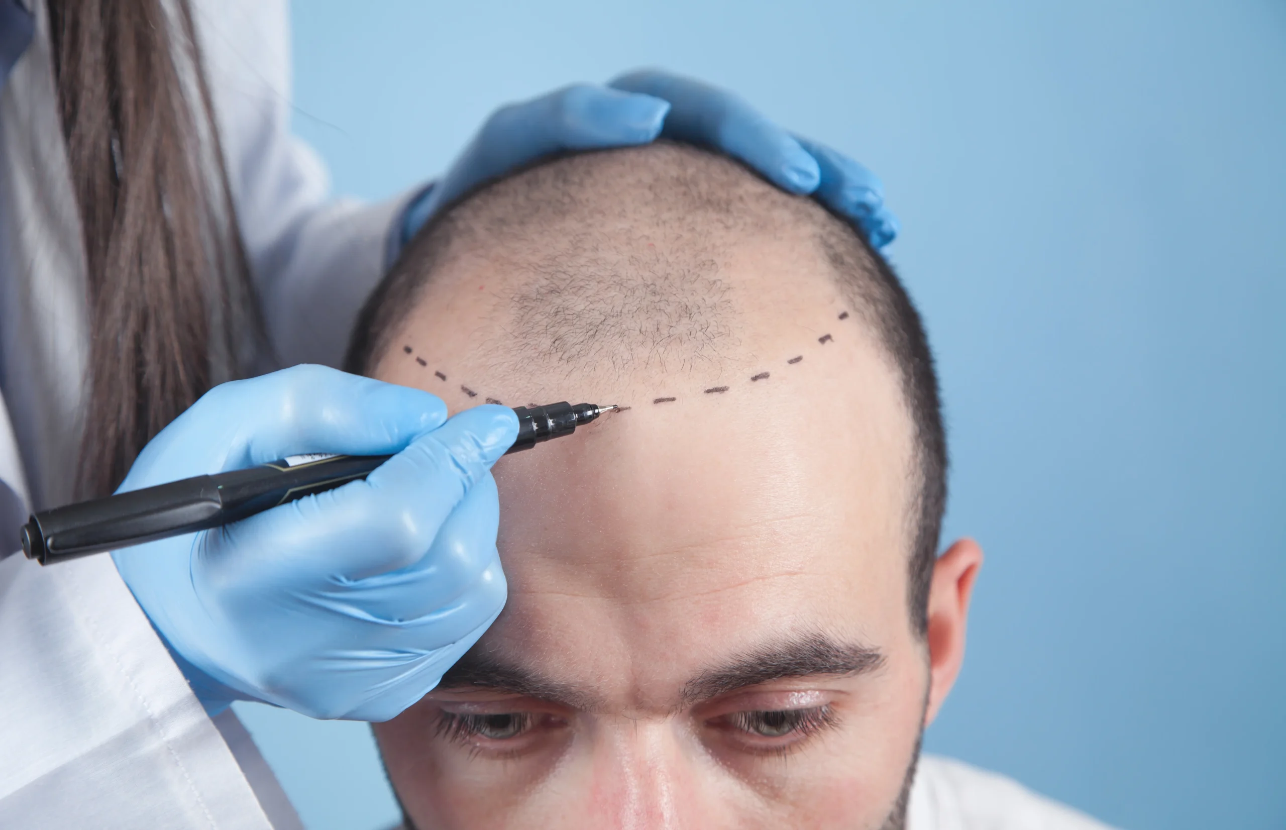 aboutus-adonismed-hairtransplant-hairline