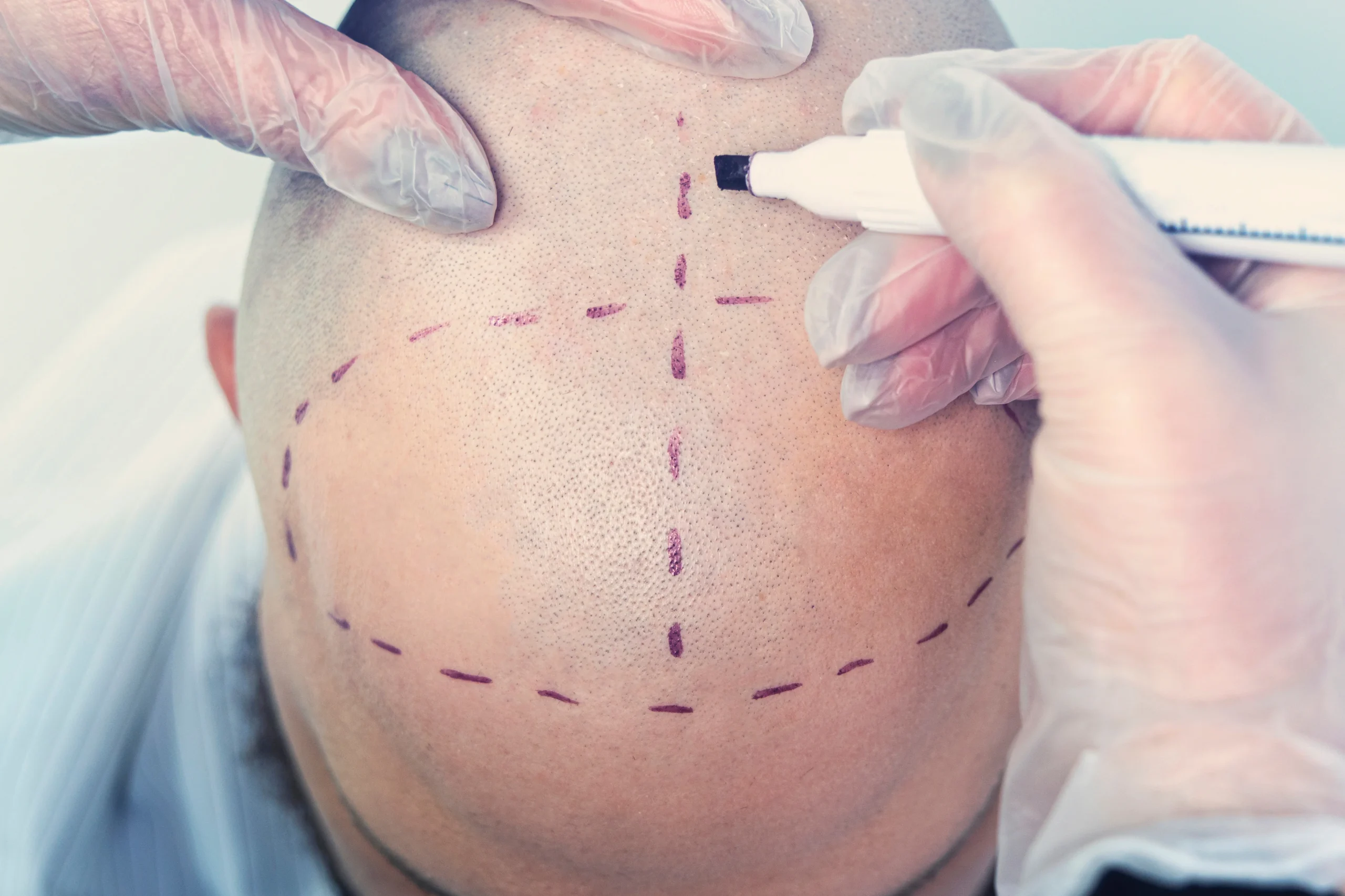 aboutus-adonismed-hairtransplant-hairline-techniques-hair
