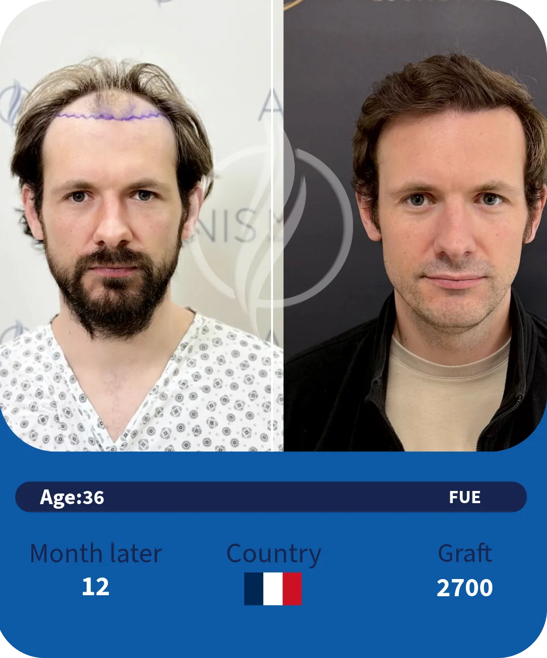 Selbstvertrauen nach der Haartransplantation: Eine Geschichte psychologischer Erneuerung