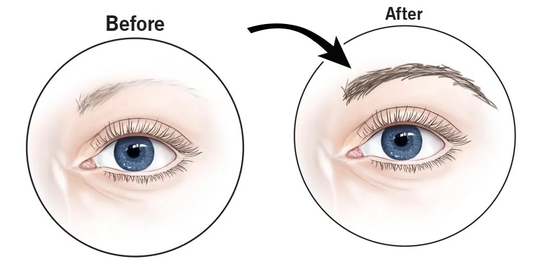 eyebrow-transplant-before-after
