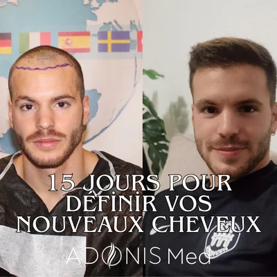 Vor ve nach der Haartransplantation: Alle Einschränkungen und Tipps, die Sie wissen müssen