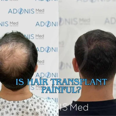 Ist eine Haartransplantation schmerzhaft? Alles, was Sie über den Prozess wissen müssen