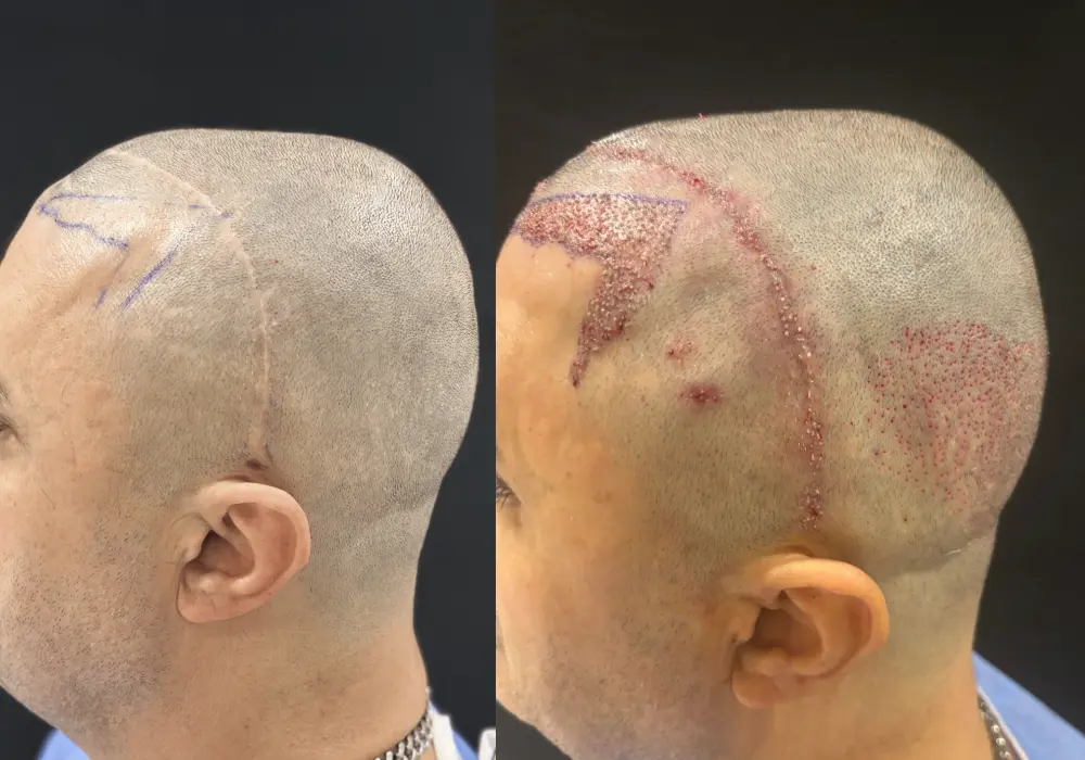 Haartransplantation auf Narbengewebe: Ist das möglich?